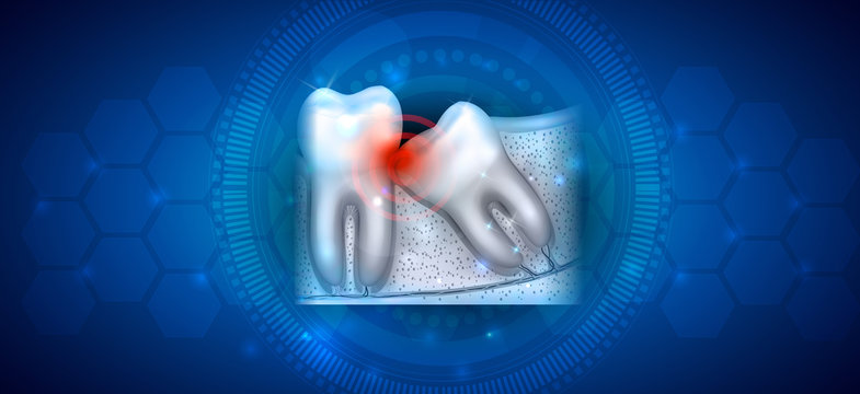 Wisdom tooth eruption problems on an abstract blue background