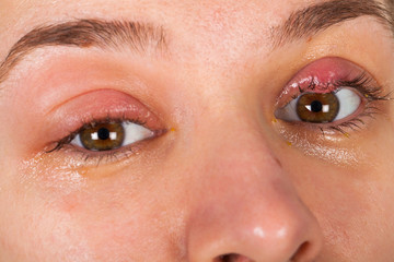 Naklejka premium Upper eyelid infection - chalazion
