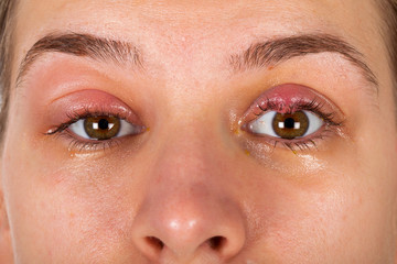 Upper eyelid infection - chalazion