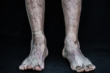 Dirty homeless drug addict legs with necrosis, gangrene, trombosis and death of tissue traces