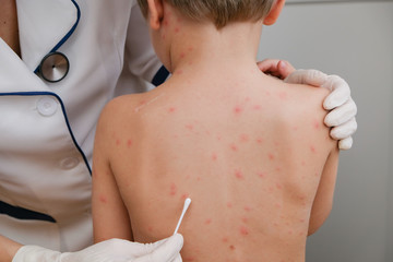 Doctor applying cream to baby's skin with blisters and rash caused by chickenpox