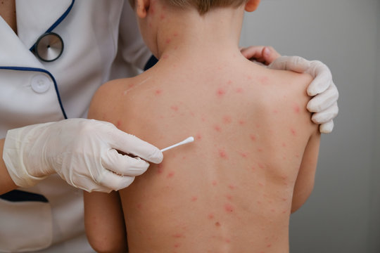 Doctor applying cream to baby's skin with blisters and rash caused by chickenpox, varicella