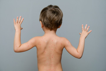 Closeup of back and neck full of blisters,scar and rash caused by chickenpox