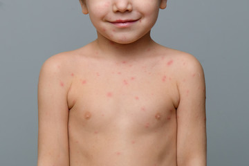 Closeup of baby's skin full of blisters,scar and rash caused by chickenpox