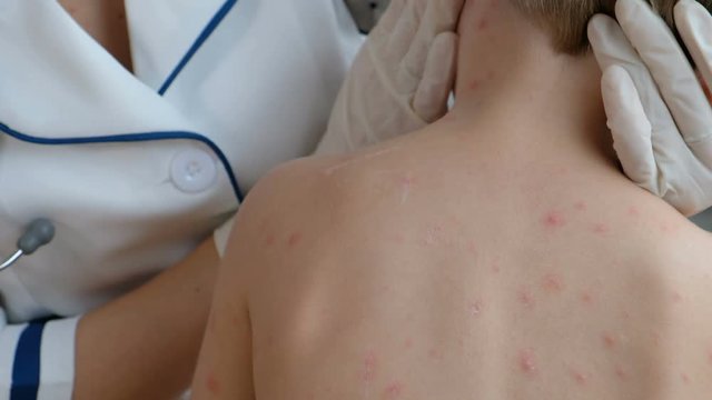 Doctor examines baby's skin full of blisters,scar and rash caused by chickenpox