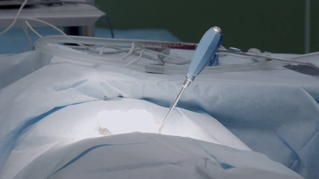 patient under general anesthesia is covered by sterile fabrics, breathing, lying on surgery table
