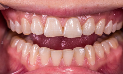 Healthy human teeth with normal occlusion from frontal intraoral view