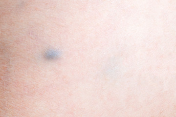 Fototapeta premium varicose vein disease in a woman, closeup image
