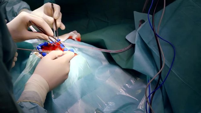 neurosurgery carries out the operation of craniotomy. preparing for the brain dissection.