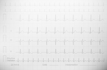 ECG drawing on the square paper