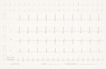 cardiogram on the linear graph paper