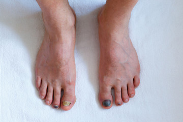 Human male foots with bruised black on toe nails on white background .
