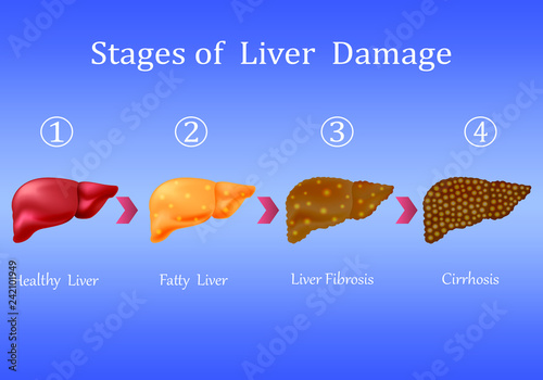 Liver Cirrhosis Final Stages