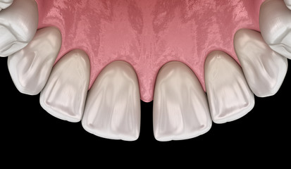 Diastema of central incisors teeth. Dental disfunction 3D illustration concept