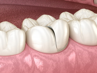 Onlay ceramic crown fixation over tooth. Medically accurate 3D illustration of human teeth treatment
