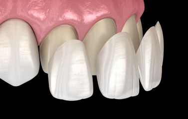 Veneer installation procedure over central incisor and lateral incisor. Medically accurate tooth 3D illustration