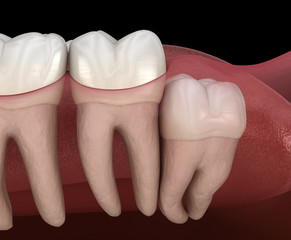 Healthy teeth and wisdom tooth with vertical impaction . Medically accurate tooth 3D illustration