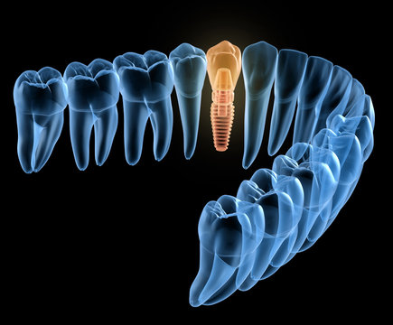 Premolar tooth recovery with implant, x-ray view. Medically accurate 3D illustration of human teeth and dentures concept