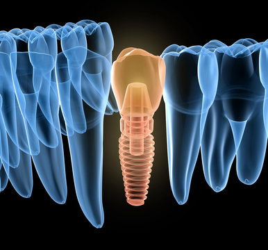 Premolar tooth recovery with implant, x-ray view. Medically accurate 3D illustration of human teeth and dentures concept