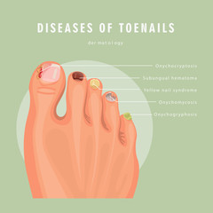 Fungus toenail infection vector medicine poster. Colorful design. Detailed image with text. © Tatsiana Tsyhanova