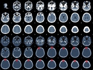 CT-Brain