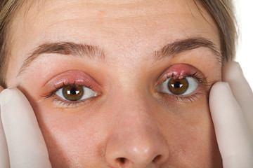 Hordeolum on upper eyelid. Viral infection