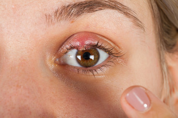 Hordeolum on upper eyelid. Viral infection