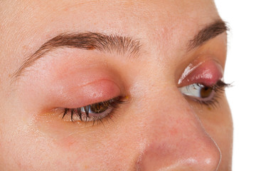 Hordeolum on upper eyelid. Viral infection