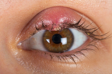 Hordeolum on upper eyelid. Viral infection