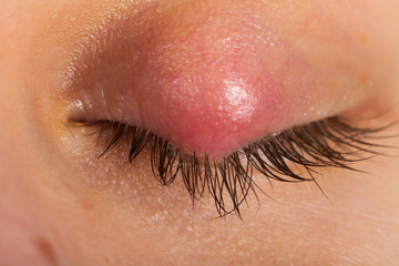 Hordeolum on upper eyelid. Viral infection