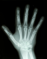 Right Hand X-Ray