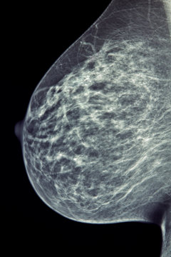 Medical X-Ray / Mammogram Image - Breast 