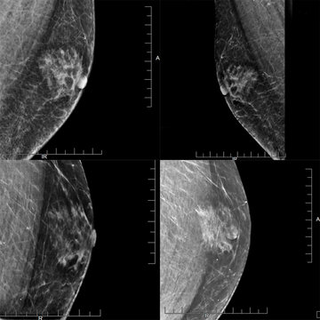 A Series of Four Mammogram images Showing a Male Patient's Gynecomastia (Benign Tumor)