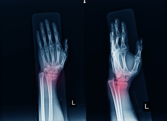 X-ray Left wrist joint Fracture with displacement distal end left radius.