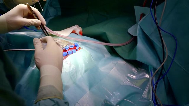 Close-up of a difficult operation on a head, team of surgeons working.