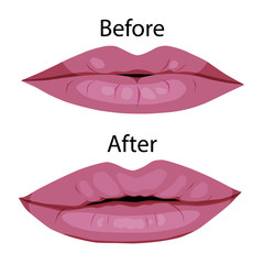 Cosmetic procedure lips augmentation. before and after. isolated on white