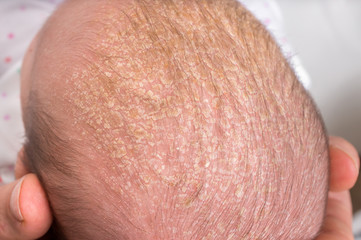 Newborn baby with psoriasis or dandruff in the hair