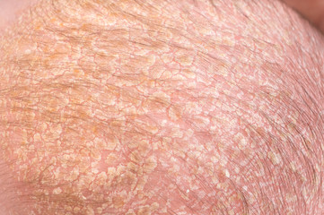 Newborn baby with psoriasis or dandruff in the hair