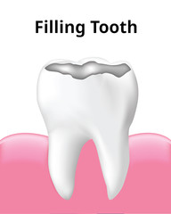 Tooth Filling with gum, isolated on white background, Realistic design illustration Vector.