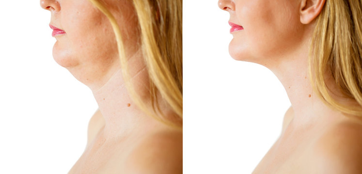 Woman before and after chin fat correction procedure