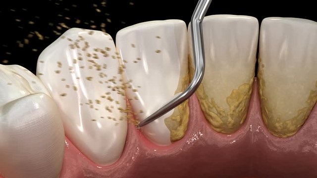 Oral hygiene: Ultrasonic teeth cleaning machine removing calculus and plaque. Medically accurate 3D illustration of human teeth treatment