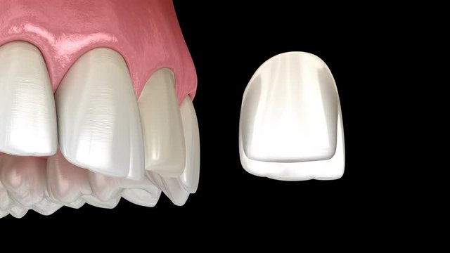 Veneer installation procedure over central incisor. Medically accurate tooth 3D illustration