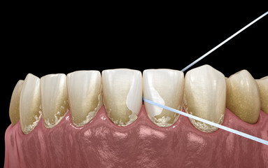 Fototapeta na wymiar Oral hygiene: using dental floss for plaque removing. Medically accurate dental 3D illustration