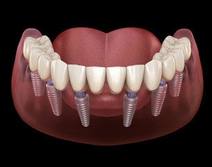Mandibular prosthesis All on 6 system supported by implants. Medically accurate 3D illustration of human teeth and dentures concept