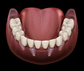 Mandibular prosthesis All on 6 system supported by implants. Medically accurate 3D illustration of...
