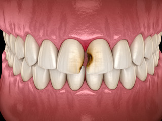 Fototapeta na wymiar Central incisor teeth damaged by caries. Medically accurate tooth 3D illustration.