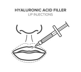 Hyaluronic acid filler. Lip injections. Vector illustration