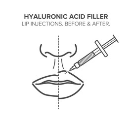 Lip injections. Hyaluronic acid filler. Before and after. Vector illustration