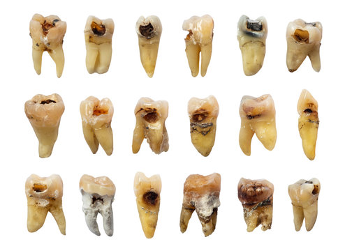 Set of teeth with dental caries ( tooth decay ) , fluorosis and calculus . isolated background