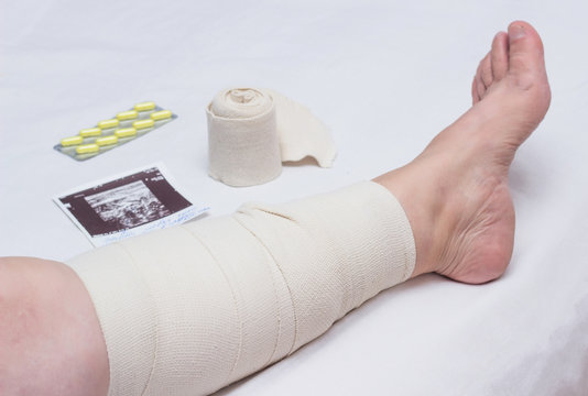 Compression Therapy For Varicose Veins In A Woman's Legs, Treatment Of Varicose Veins With An Elastic Bandage, Vascular